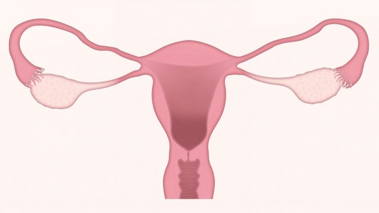 POLYCYSTIC OVARIAN DISEASE