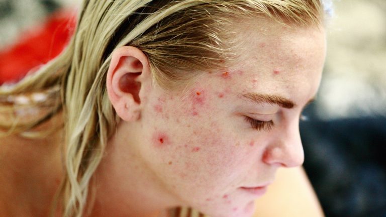 What to do if you have acne?