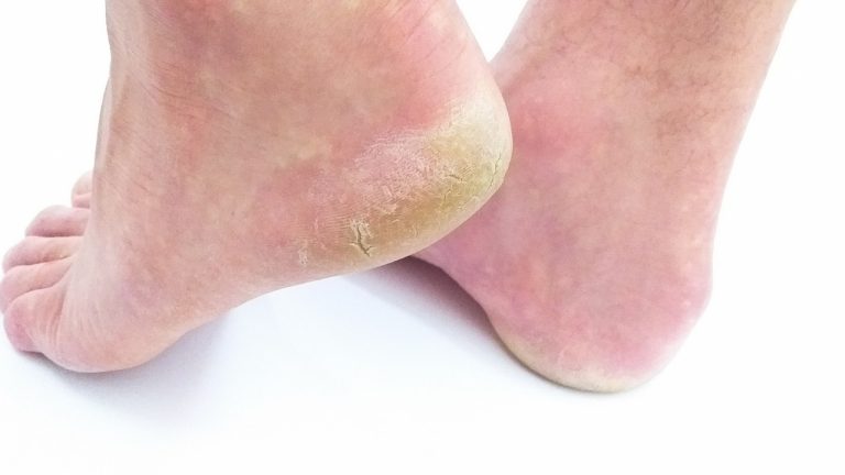 Natural Treatment For Cracked Heels