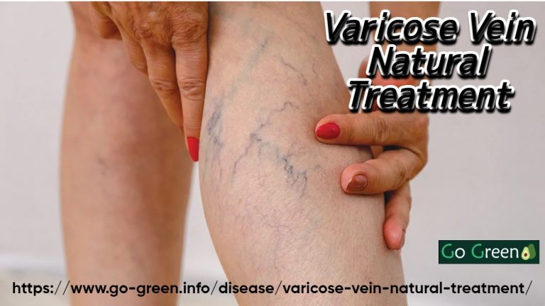 Varicose Vein Natural Treatment