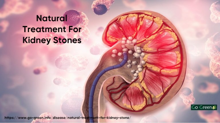 Natural Treatment For Kidney Stone