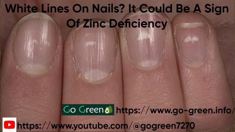 White Lines On Nails? It Could Be A Sign Of Zinc Deficiency