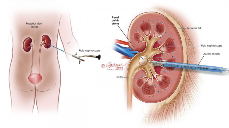 How Beneficial Is Barley Water For Kidney Stones?