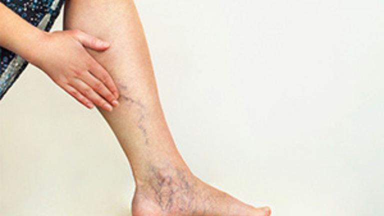 Deep Vein Thrombosis Natural Treatment
