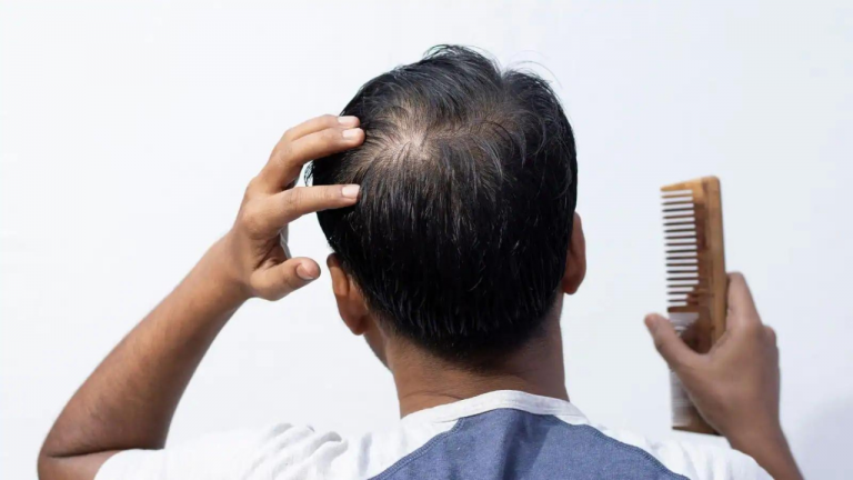 Best Hair Loss Natural Treatment For Men