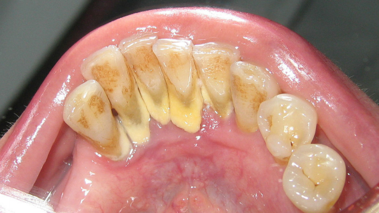 Ways To Remove Dental Plaque Naturally