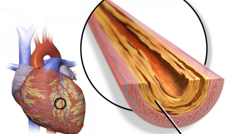 How To Cleanse Coronary Arteries