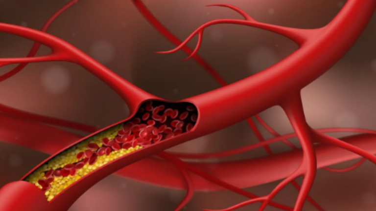 How do I Control the High Cholesterol Level of Old Women?