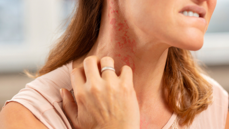 How Do I Get Rid Of a Tomato Allergy?