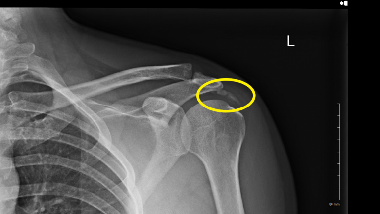 Is There Any Help With Natural Supplement For Small Calcific Peritonitis?