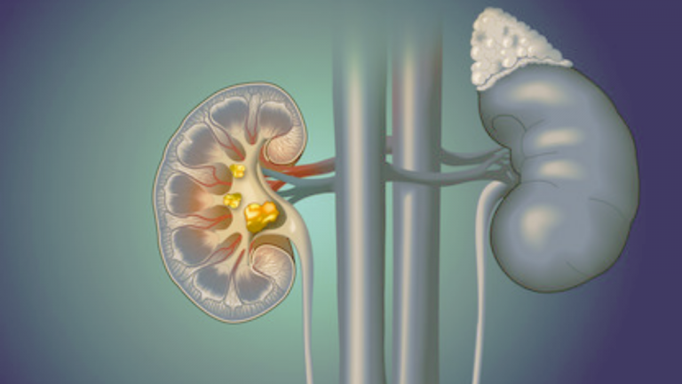 How Significant is this Dietary Change in Patient Kidney Stones?