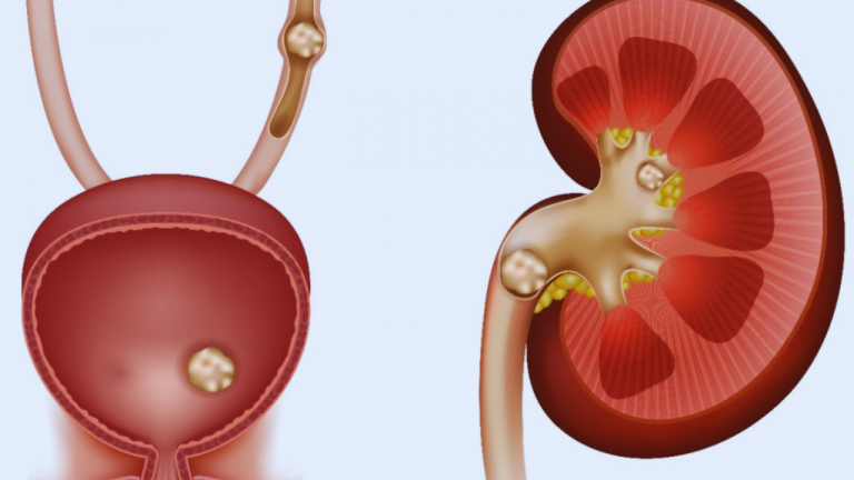 What are the Foods Allowed and Not Allowed for Kidney Stones?
