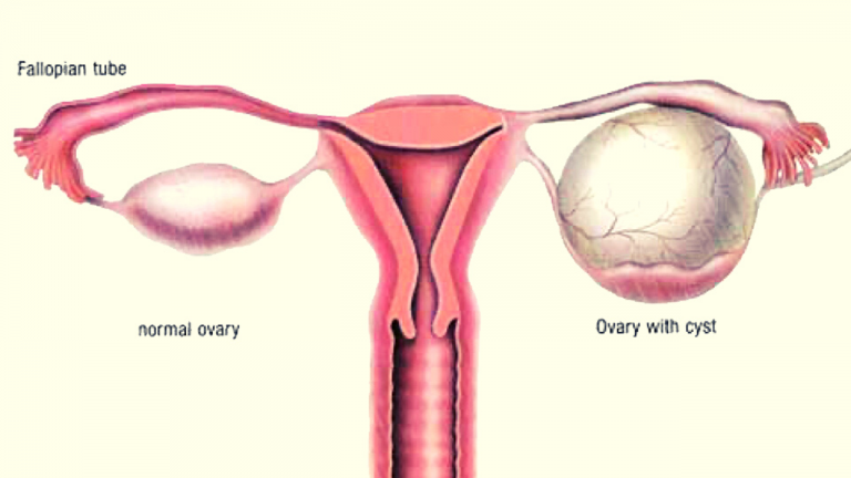 What Does it mean if there is an Ovarian Cyst on a Pregnancy Test?
