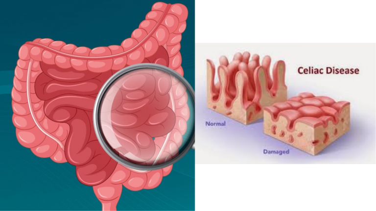 Can IBS or Celiac Disease be Passed Down Through Families?