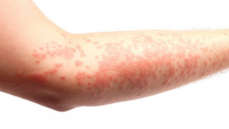 What are Some Common Food Additives That Can Trigger Allergic Reactions?
