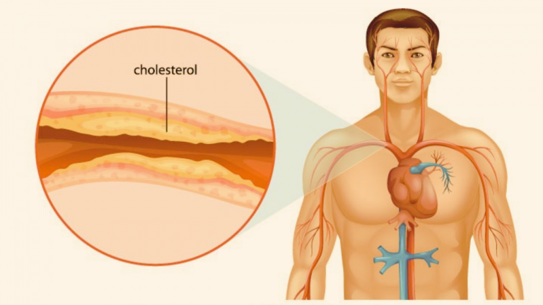 Coronary Heart Disease be Reversed Through Natural Healing, Whole Foods and Lifestyle Changes?