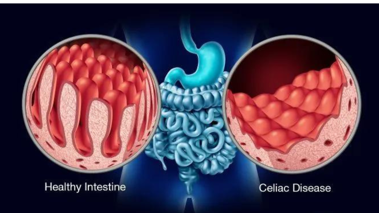 What is the Difference Between Celiac Disease, a Gluten Allergy, And