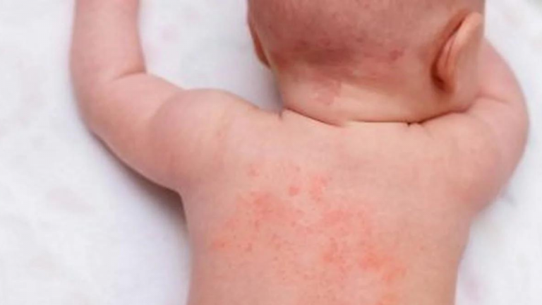 What are Some Signs That Your Baby May be Allergic to Certain Foods, and How Can You Introduce New Foods Safely?