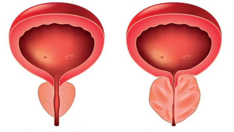 Why Does Your Prostate Enlarge?