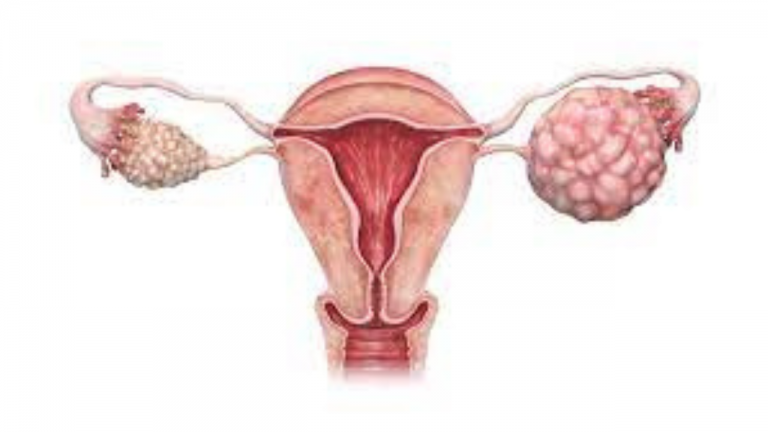 PCOS Can Cause Multiple Ovarian Cysts