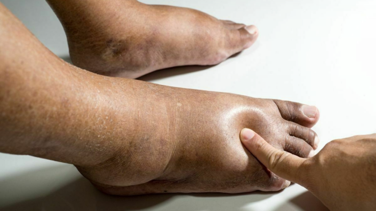 Fluid Retention