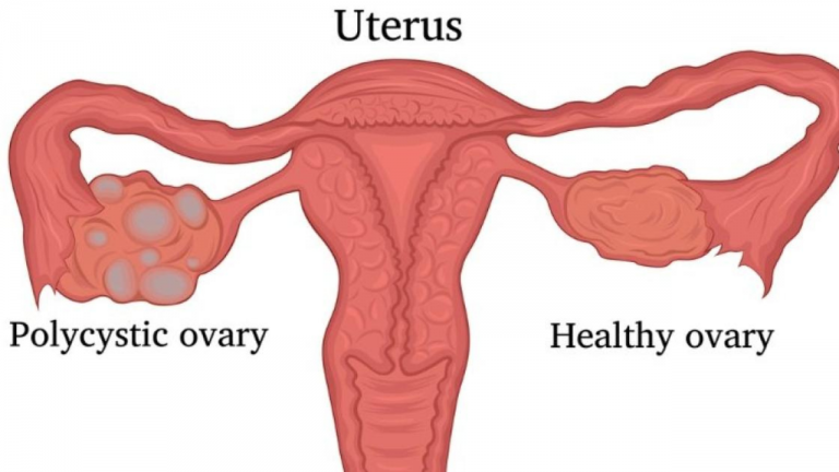 LH & FSH Hormone Role in PCOS