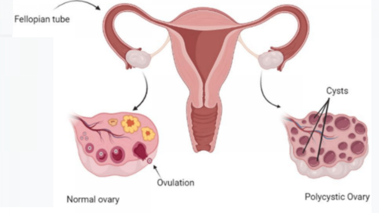 Understanding Hormones Involved in PCOS