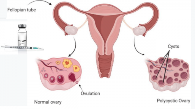 Insulin Hormone Role in PCOS