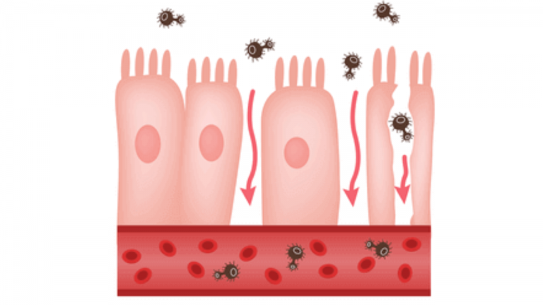 Preventing Leaky Gut With Dietary and Lifestyle Strategies