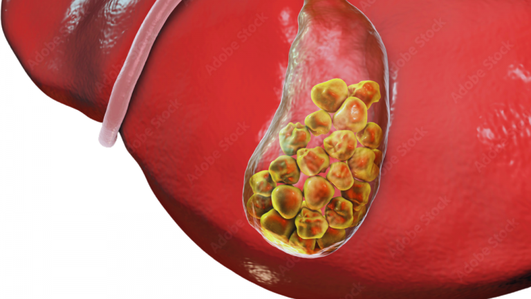 Natural Dietary Guidelines and Home Remedies for Gallbladder Stone Removal