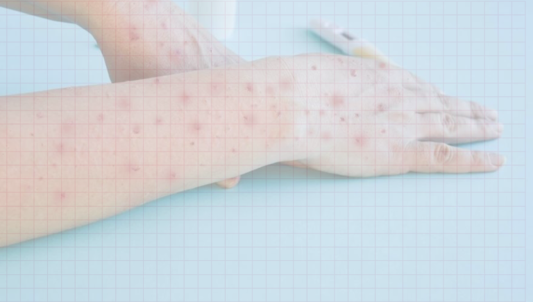 Mpox Explained: A Guide to Symptoms, Care, and Prevention